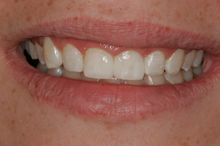 After Porcelain Veneers and Cosmetic Dentistry Procedure
