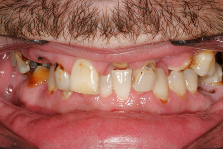 Before Denture Procedure
