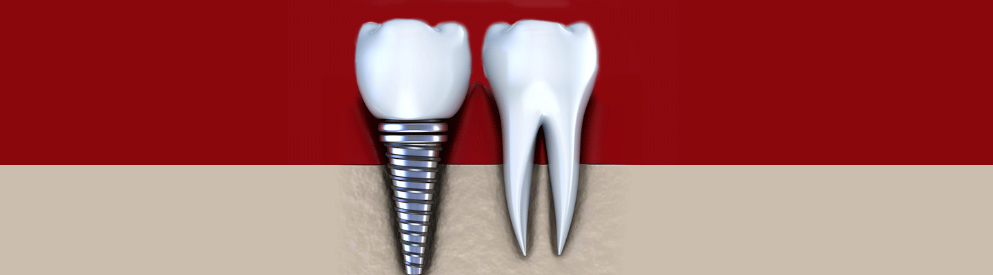 affordable dental implants