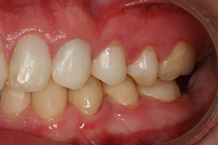 After Bonding and Restoration Dental Procedure