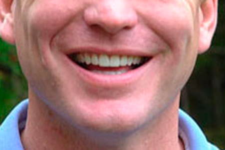 After Cosmetic Dentistry Procedure