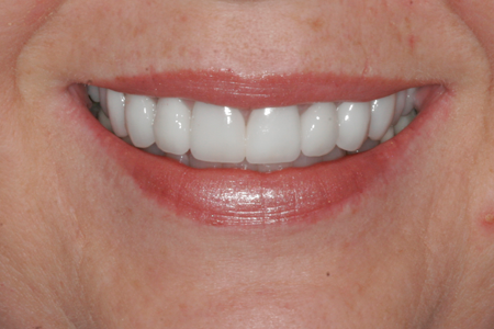 After Full Mouth Restoration Procedure