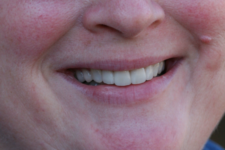 After Dental Veneers and Orthodontics Procedure