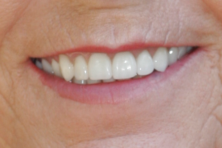 After Dental Crowns Procedure