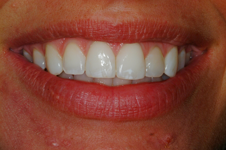After Full Mouth Restoration and Occlusal Rehabilitation Procedure