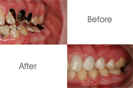 Before and After Bonding and Restoration Dental Procedure