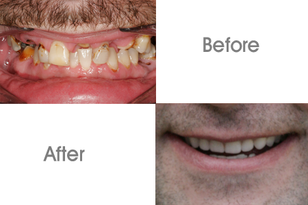 Before and After Denture Procedure