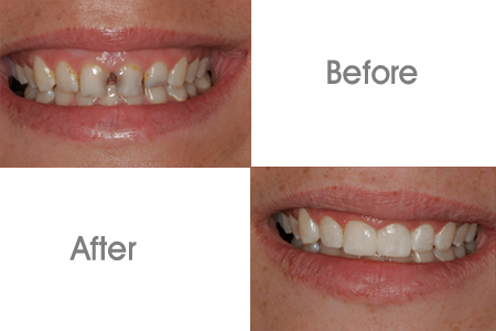  Gainesville Cosmetic Dentistry Before and After Images