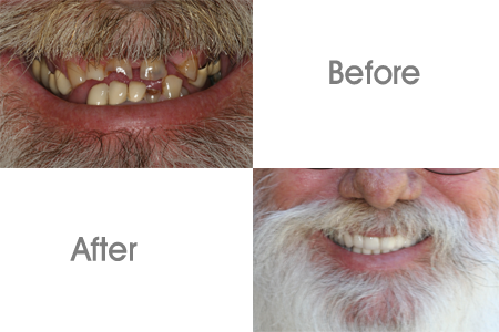 Before and After Porcelain Veneers and Cosmetic Dentistry Procedure