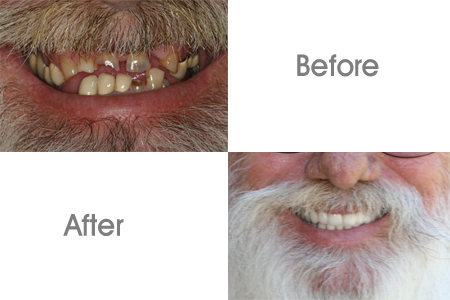 Before and After Porcelain Veneers Procedure