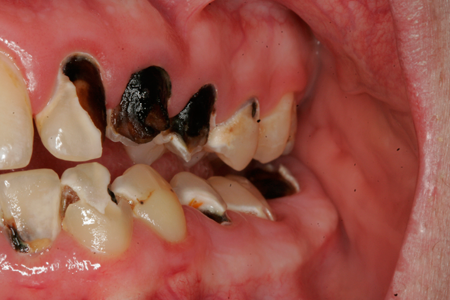 Before Bonding and Restoration Dental Procedure