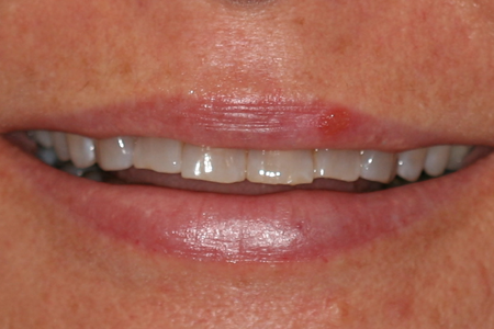 Before Dental Bonding and Diastima Closure Procedure