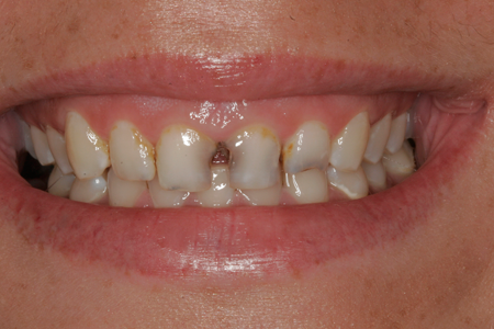 Before Porcelain Veneers and Cosmetic Dentistry Procedure