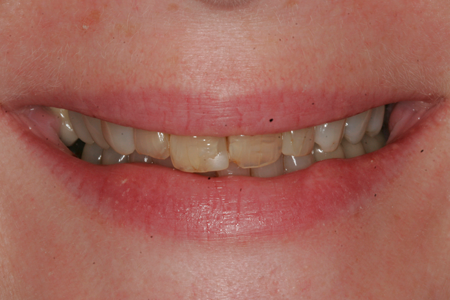 Before Dental Veneers and Orthodontics Procedure