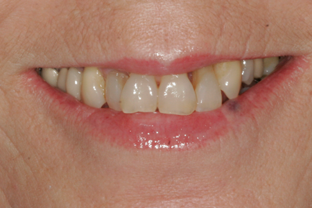 Before Dental Crowns Procedure