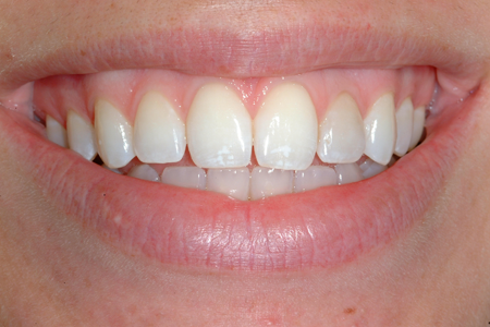 Before Full Mouth Restoration and Occlusal Rehabilitation Procedure
