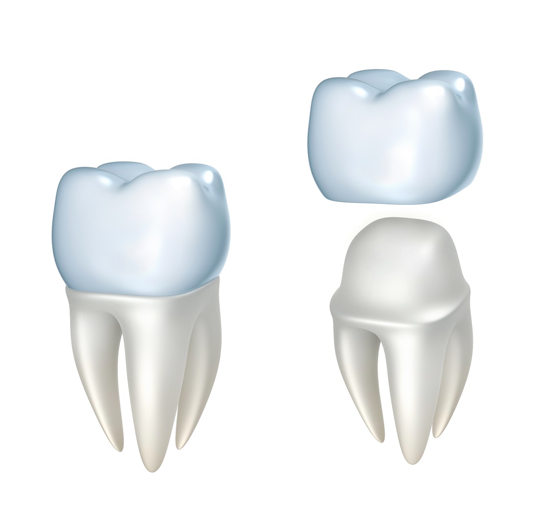 Veneers vs. Crowns: What to Know