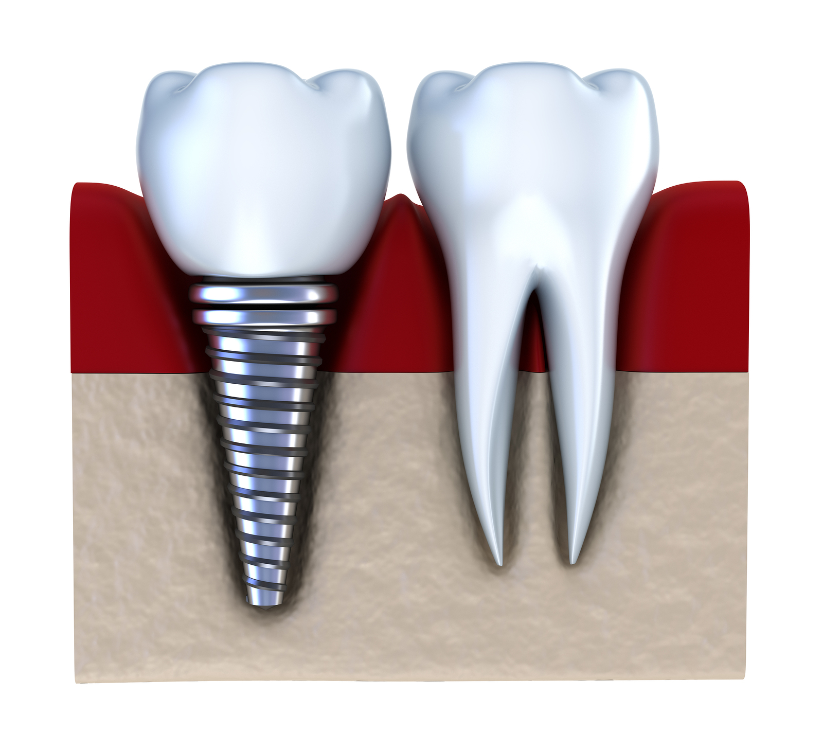 titanium dental implants