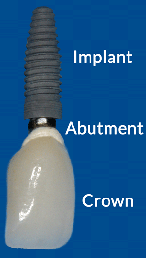 dental implant diagram