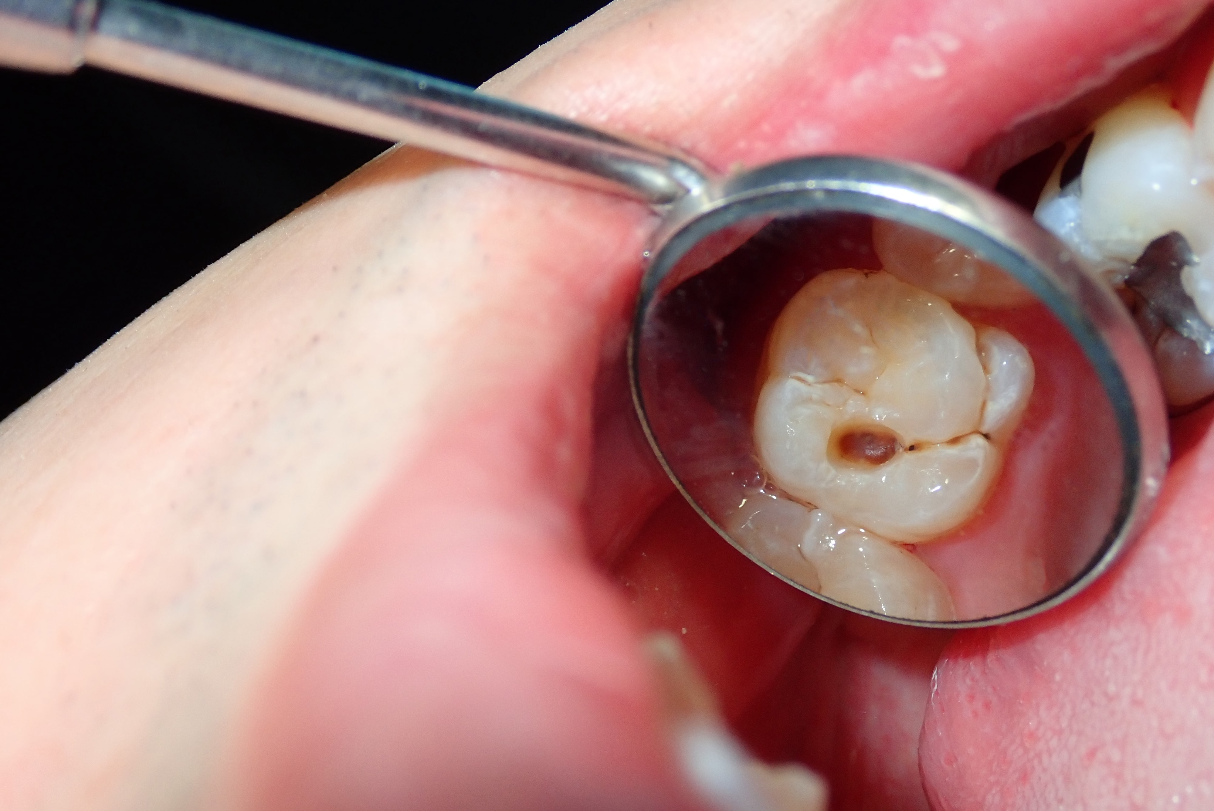 What Do Cavities Look Like Before The Treatment